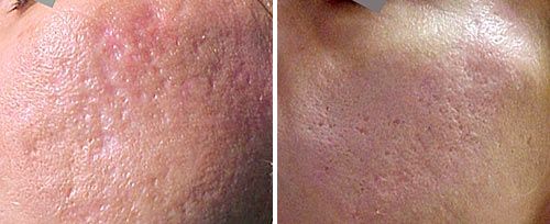 acne_scars_dr_luppino