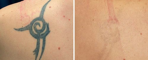 tattoo_removal_dr_ahcan3