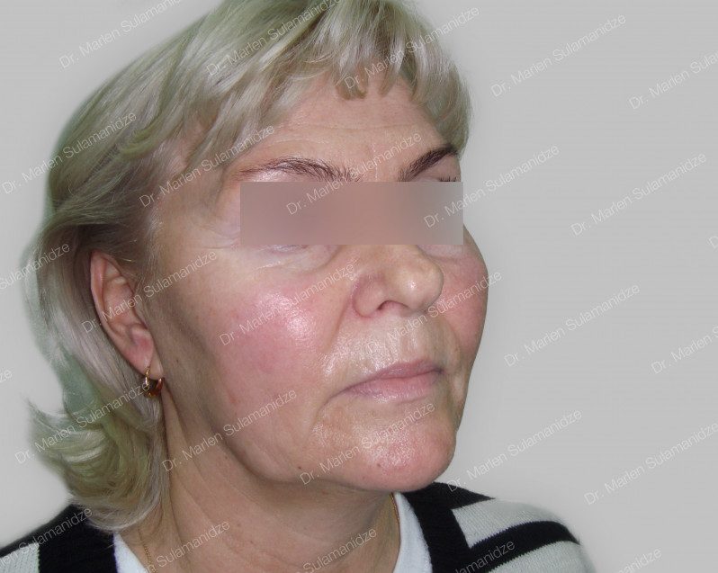 inainte Light Lift METODA arcului moale